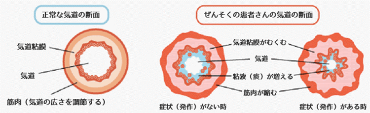 ぜんそく画像2